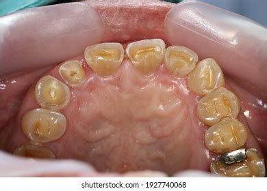 Severe Teeth Attrition Loss Vertical Dimension Stock Photo 1927740068 ...