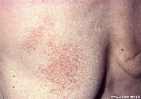 Sarklíki (Sarcoidosis) - Útlitslækning