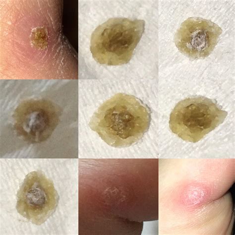 Plantar Wart Pulled Out at Frederick Rosado blog