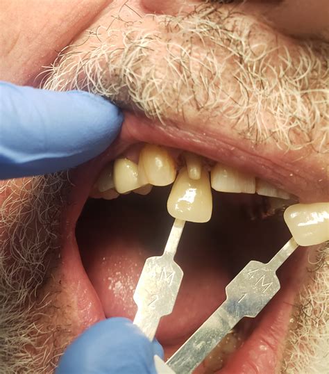 avoiding remakes with effective intraoral dental photography - Whatcom