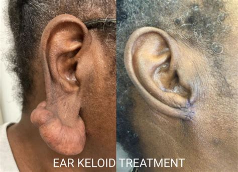 Ear Keloid Treatment: Specialised Approaches for Complex Cases - London