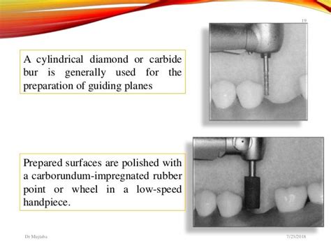 Preparation of abutment teeth