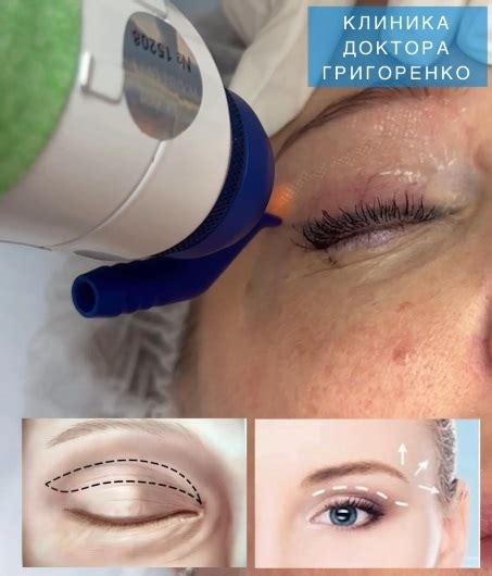 Лазерная шлифовка верхних и нижних век