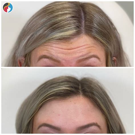 Botox Treatment | Syracuse, Albany, Rochester, New Hartford