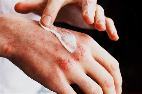 Understanding The Different Types Of Eczema | Garden City, NY & Syosset ...