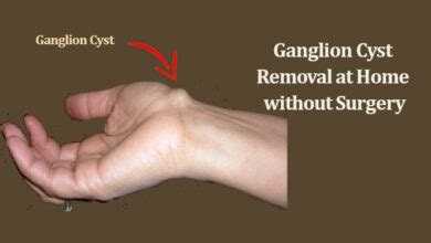 What is a Ganglion Cyst? Ganglion Cyst Removal without Surgery