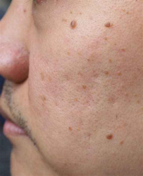moles brown spots pigmented lesions treatment removal