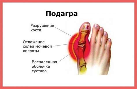 Подагра: признаки, симптомы, диагностика и лечение