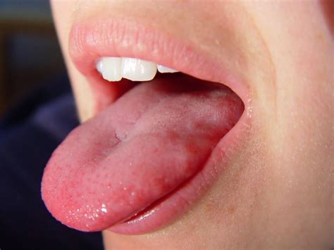 5 Early Symptoms Of Tongue Cancer - ebuddynews