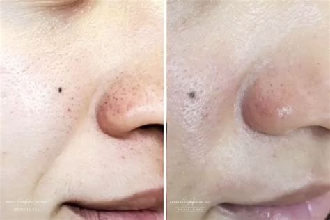 Unbelievable Blackhead Removal 2024: Before & After Photos Will Blow Your Mind! - vtjv7fi