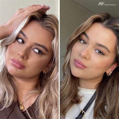 Before and After treatment pictures - M1 Med Beauty BG
