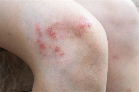 Non Itchy Bumps On Elbows