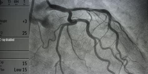 disclosure  patient information  douglass angiogram