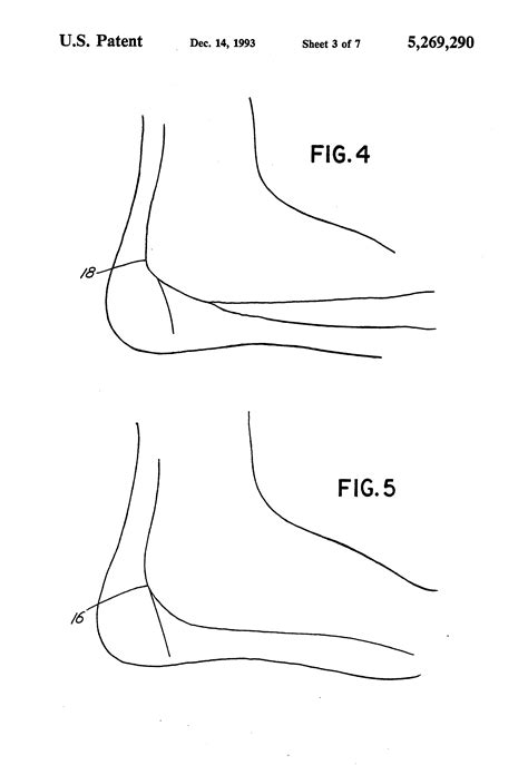 What Causes Mortons Neuroma | fallonlambros