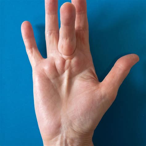 occupational based hand therapy hand therapy   occupational