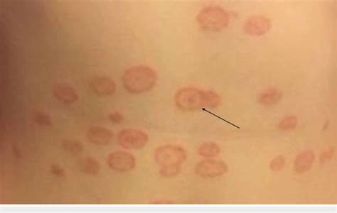 Annular, erythematous lesions on the torso with central clearing and ...