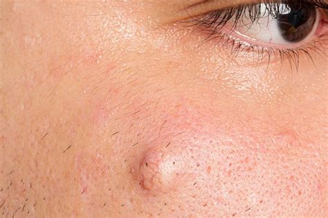 Foto : Penyebab Kista Epidermoid dan Kapan Harus ke Dokter