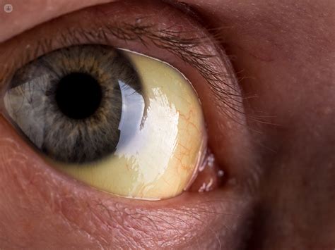 Causes Of Jaundice Eyes