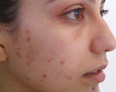 perfect peel  acid blended chemical peel  glutathione