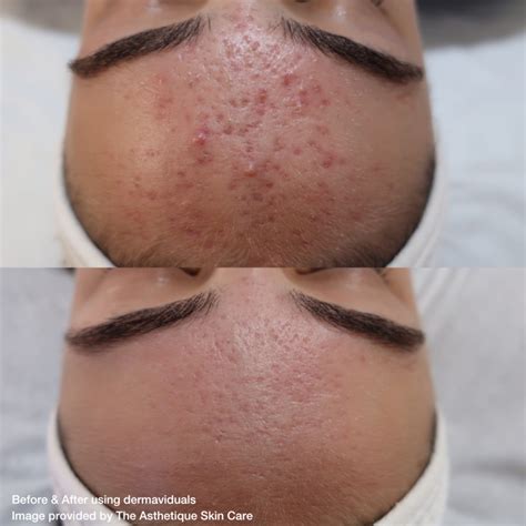 educational series   acne dermaviduals
