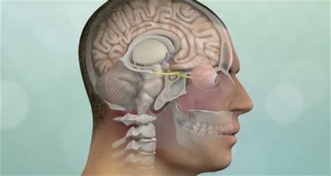 Epidermoid Cyst Removal & Surgery | Brain Tumor Center