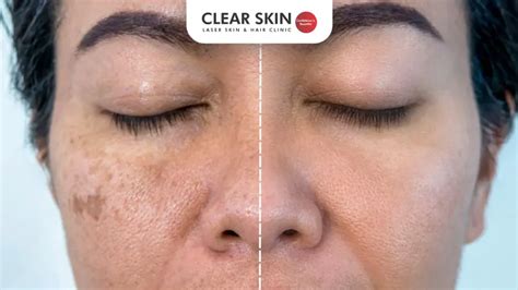 melasma  treatments deficiency insights clear skin