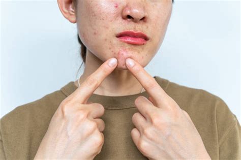 810+ Lip Sores Stock Photos, Pictures & Royalty-Free Images - iStock