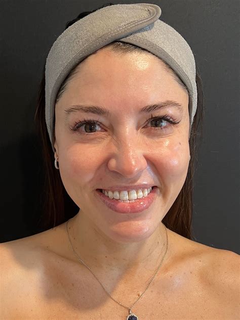 What Is the HydraFacial Treatment and Why Is It So Popular? | Allure