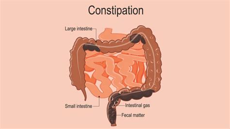 X Ray Of Severe Constipation