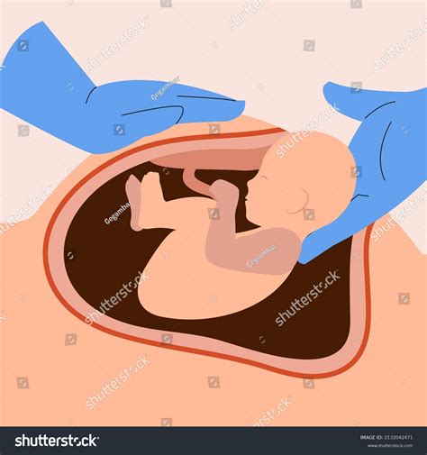 Illustration C-section Cesarean Process Stock Vector (Royalty Free