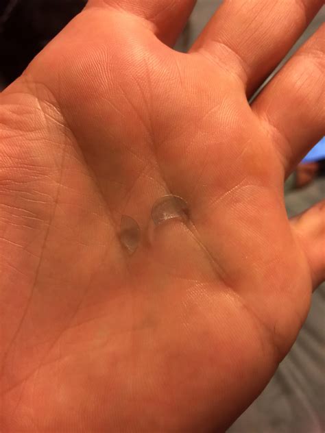 Today, I lost my left eye... : r/Keratoconus