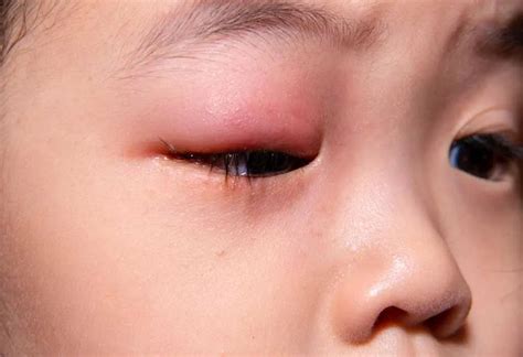 Stye in Child's Eye: Types, Causes, Signs, and Treatment