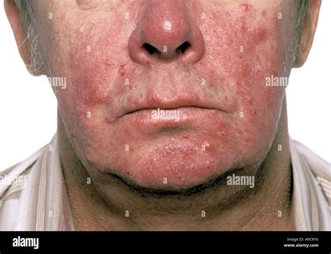 Acne rosacea hi-res stock photography and images - Alamy