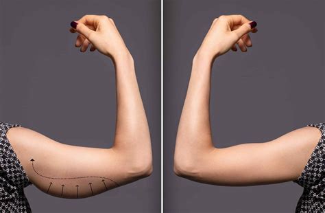 Arm Lifts - Everything You Need to Know | Dr Finkel MD