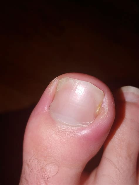 Ingrown again? Got a partial nail removal awhile ago. (Painful for a
