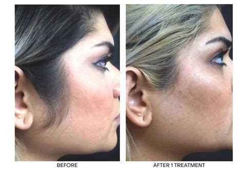 Soprano Laser Hair Removal Ontario | Permanent Hair Reduction