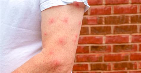 Mosquito Bites Swelling