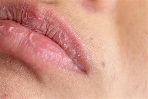 Boca Queimada De Sol - Cómo curar los labios quemados por el sol - ¡Descubre los síntomas y ...