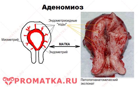 Все об Эндометриозе