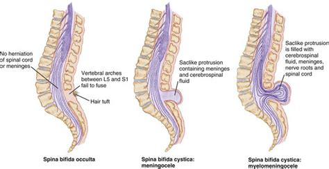 Spina Bifida | Справка.Неинвалид.ru