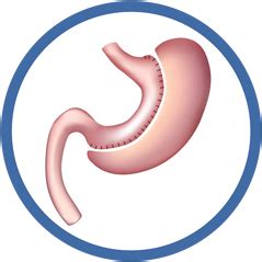 Sleeve Gastrectomy | Dr Sanjay Borude