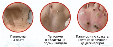 Гел писалка за брадавици и бенки Moles Remover – Yves