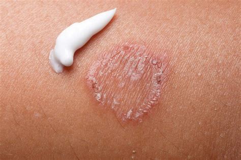 Skin Rash Best Treatment at Anna Wilson blog