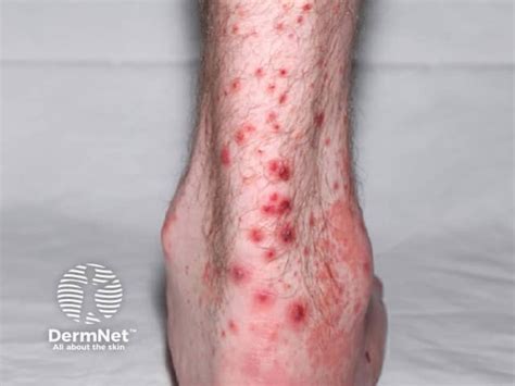 henoch schonlein purpura henoch schonlein purpura hsp information