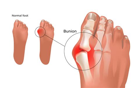 Bunions | My Doctor Online