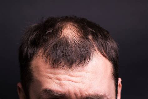 thinning hair   treatment prevention elithair