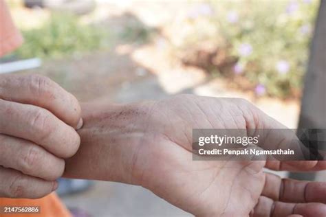 scab skin stock  high res pictures  images getty images