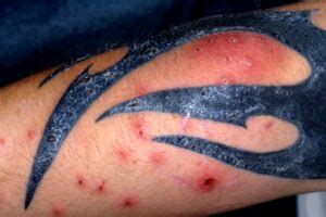 Como Saber Se A Tatuagem Inflamou - Alergia Ou Inflamação Na Tatuagem? Como Identificar E Cuidar