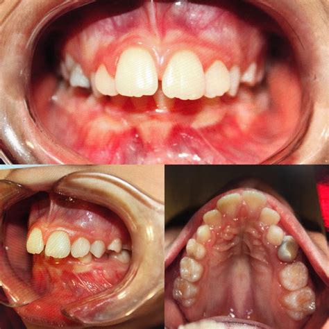 Eric Davis Dental - Buck Teeth: The Causes and Treatment for Buck Teeth