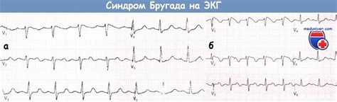 Прогноз синдрома Бругада. Катехоламинергическая полиморфная ...